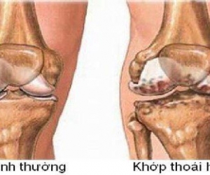 THOÁI HÓA KHỚP