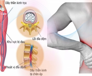Điều Trị Đau Thần Kinh Tọa Do Thoát Vị Đĩa Đệm, Lồi Đĩa Đệm