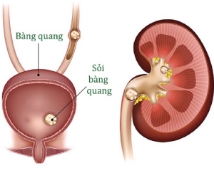 Y học cổ truyền trị sỏi thận tận gốc