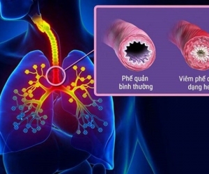Điều Trị Hen Suyễn, Viêm Phế Quản Mãn Tính