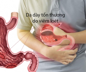 Viêm loét dạ dày