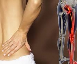 Điều trị đau thần kinh tọa