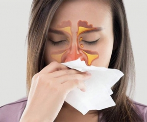 Điều Trị Viêm Xoang